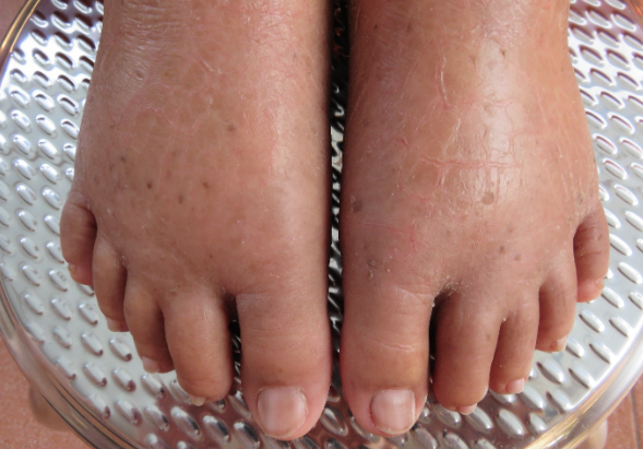 Feet with Lymphoedema.